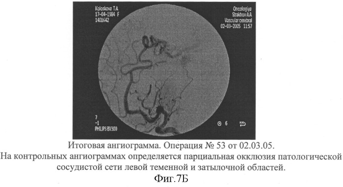 Способ эмболизации артериовенозных мальформаций головного мозга в условиях общей анестезии и управляемой гипотонии (патент 2315634)