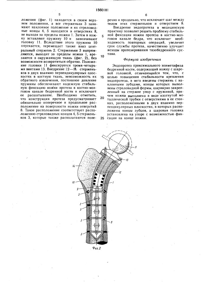 Эндопротез проксимального эпиметафиза бедренной кости (патент 1560181)