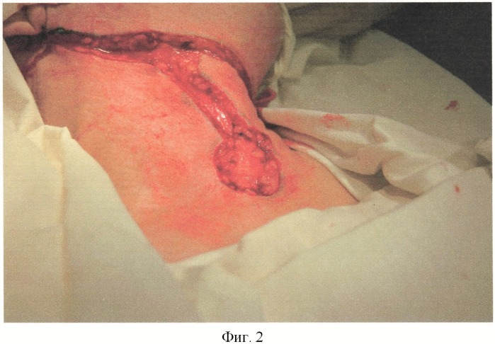 Способ разреза кожи при одномоментном выполнении ларингэктомии и фасциально-футлярного иссечения клетчатки шеи (патент 2385676)