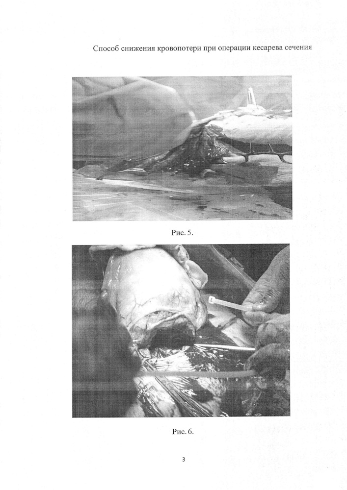 Способ снижения кровопотери при операции кесарева сечения (патент 2638459)