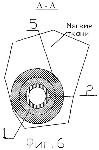 Устройство для лечения предстательной железы (патент 2385705)