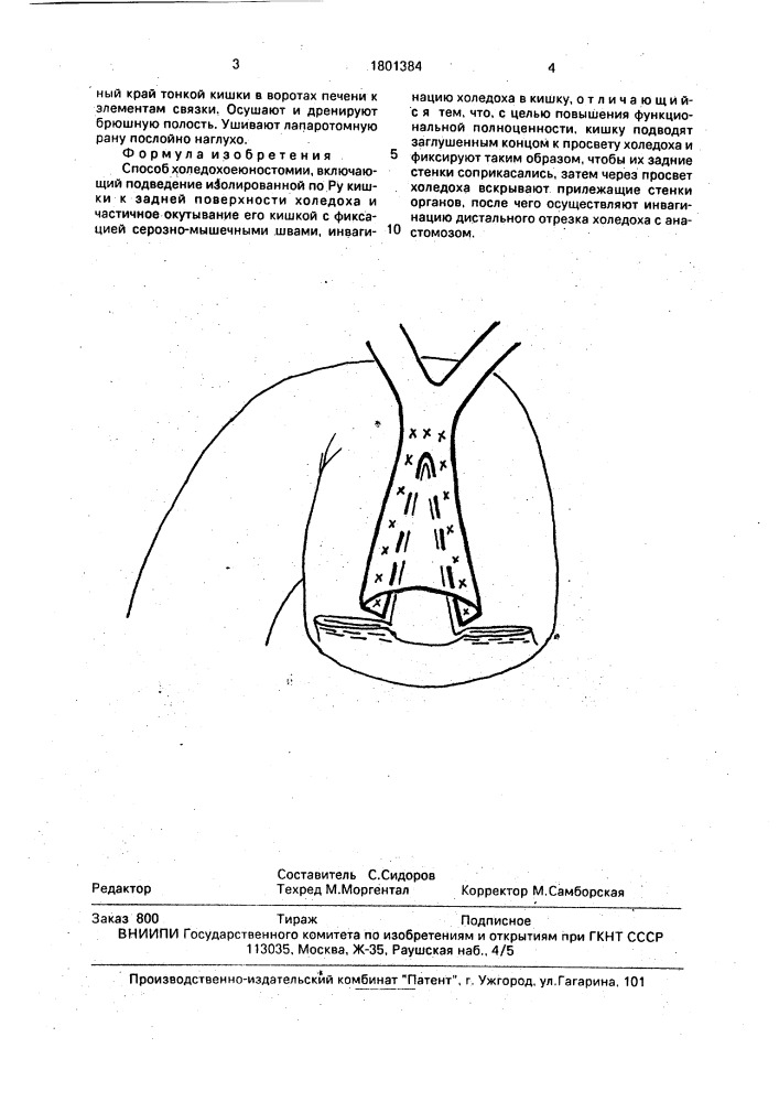 Способ холедохоеюностомии (патент 1801384)