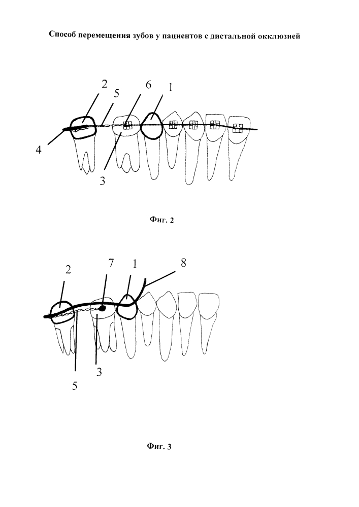 Способ перемещения зубов у пациентов с дистальной окклюзией (патент 2641000)