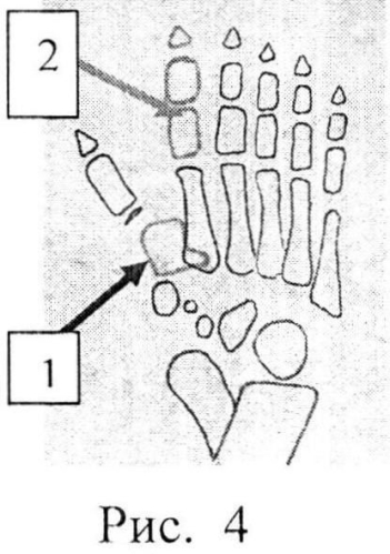 Способ хирургического лечения сложной формы полного удвоения первого луча стопы у детей (патент 2556786)
