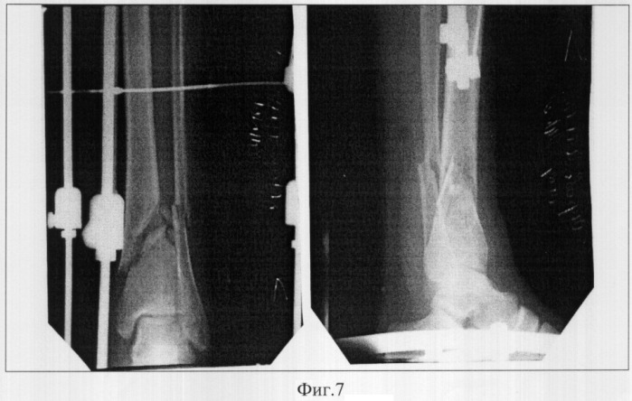 Способ лечения переломов костей голени (патент 2302835)