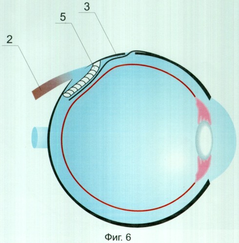 Способ супраувеальной декомпрессии ампулы вортикозной вены глазного яблока (патент 2312644)