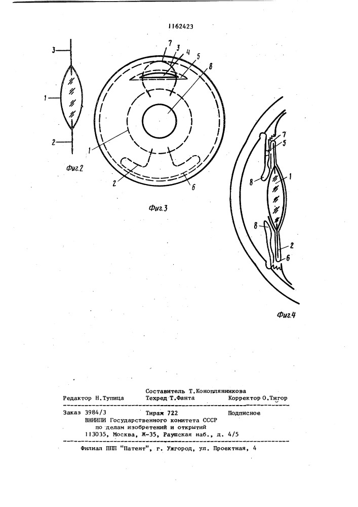 Способ имплантации искусственного хрусталика (патент 1162423)