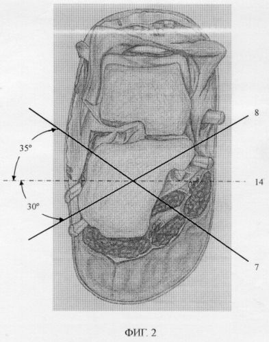 Способ лечения оскольчатых переломов пяточной кости (патент 2283628)