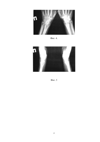 Способ лечения посттравматических деформаций дистального отдела лучевой кости, сочетающихся с контрактурами кистевого сустава и суставов предплечья (патент 2585424)