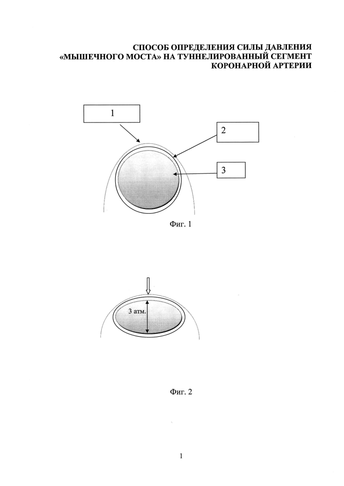 Способ определения силы давления "мышечного моста" на туннелированный сегмент коронарной артерии (патент 2599196)
