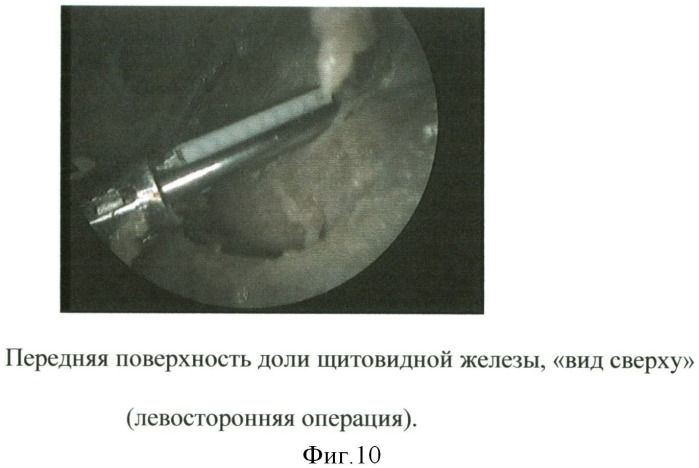 Способ эндовидеохирургического доступа к доле щитовидной железы (патент 2500355)