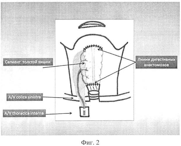Способ микрохирургической реконструкции глотки и шейного отдела пищевода толстокишечно-сальниковым аутотрансплантатом у онкологического больного (патент 2565836)