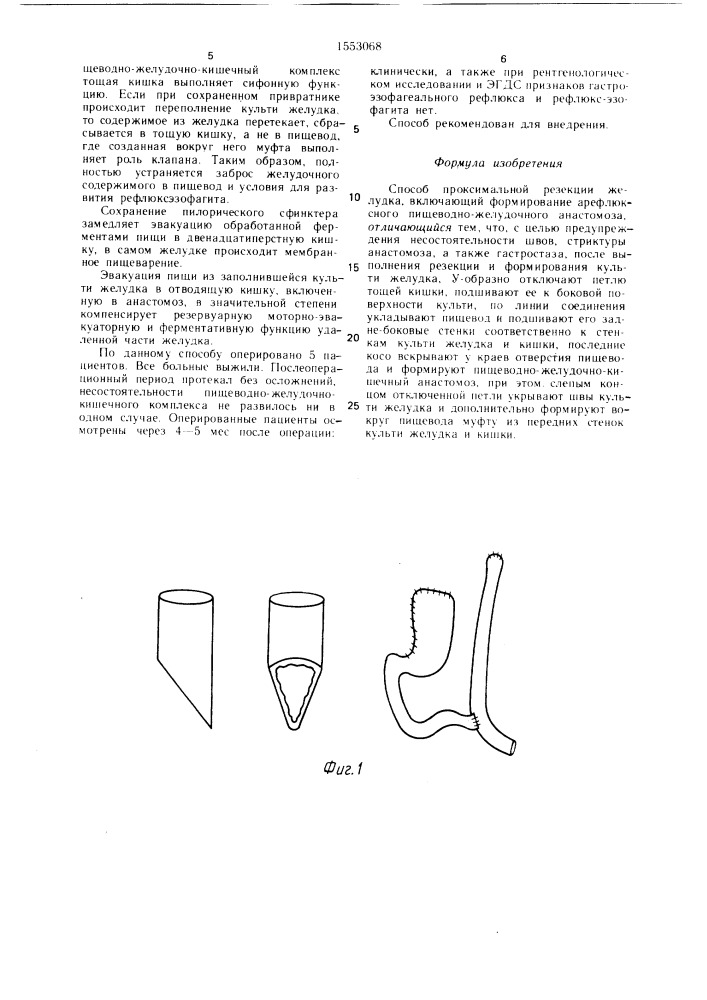 Способ проксимальной резекции желудка (патент 1553068)