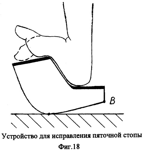Способ и устройство для исправления дефектов стопы (патент 2301039)