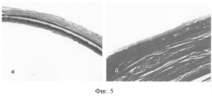 Способ укрепления склеры (патент 2265441)
