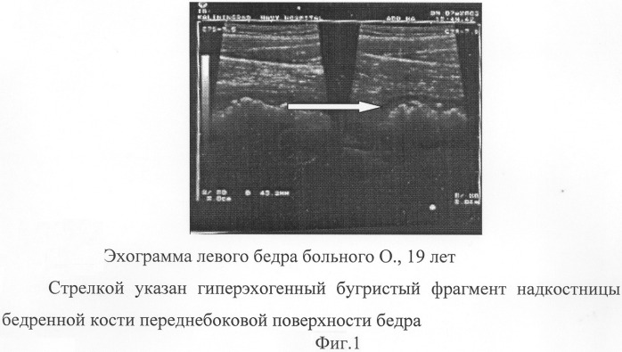 Способ ранней ультразвуковой диагностики периостита трубчатых костей (патент 2277858)