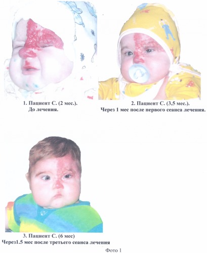 Способ консервативного лечения гемангиомы придаточного аппарата глаза и орбиты у детей (патент 2316295)