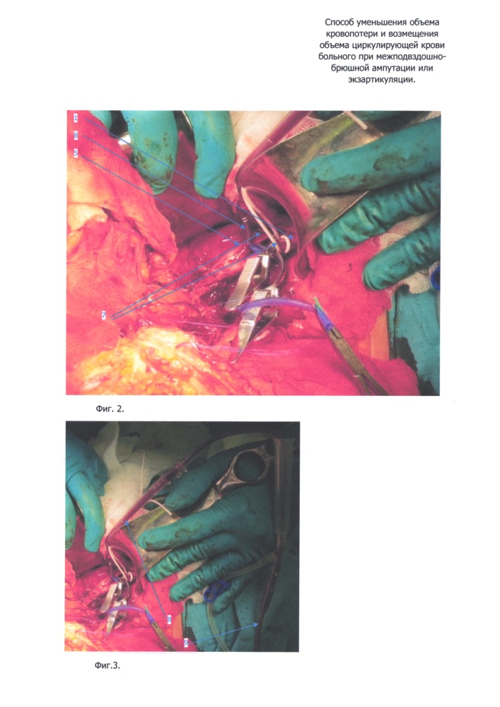 Способ уменьшения объема кровопотери и возмещения объема циркулирующей крови больного при межподвздошно-брюшной ампутации или экзартикуляции (патент 2621561)