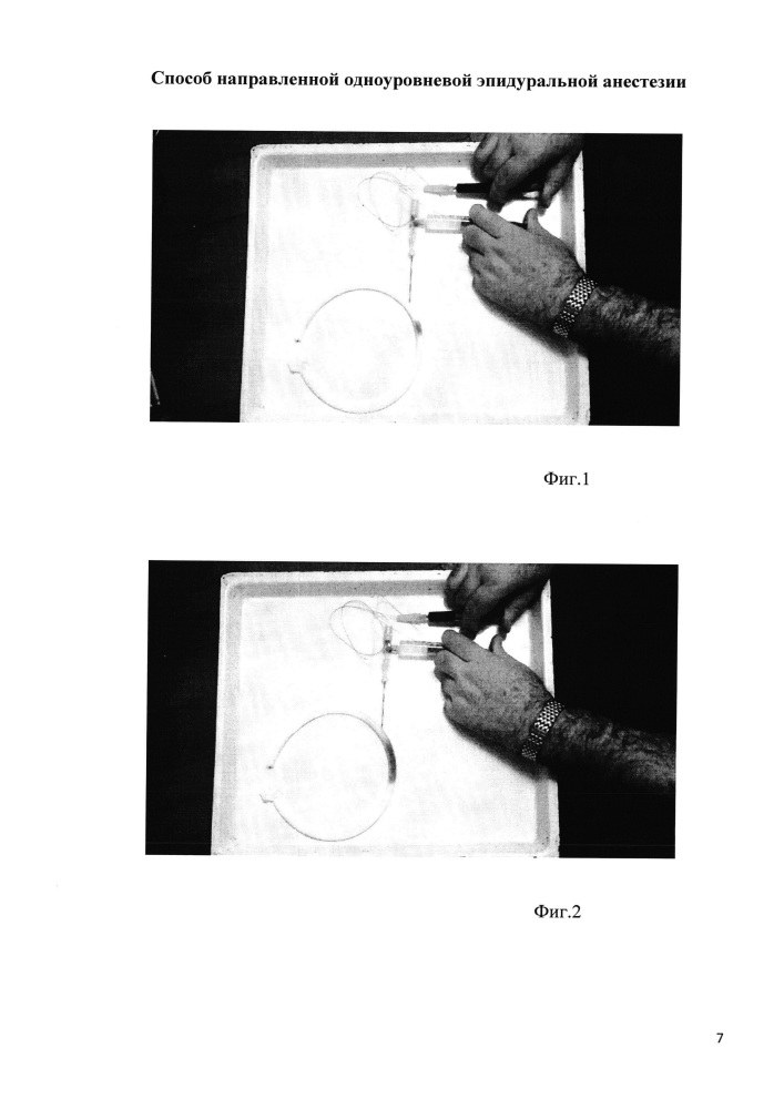 Способ направленной одноуровневой эпидуральной анестезии (патент 2651129)