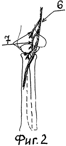 Способ устранения пронационной контрактуры предплечья в сочетании со сгибательной контрактурой лучезапястного сустава и пальцев у больных спастическим параличом (патент 2343864)
