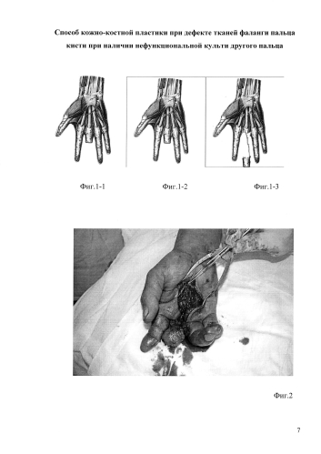 Способ кожно-костной пластики при дефекте тканей фаланги пальца кисти при наличии нефункциональной культи другого пальца (патент 2586311)