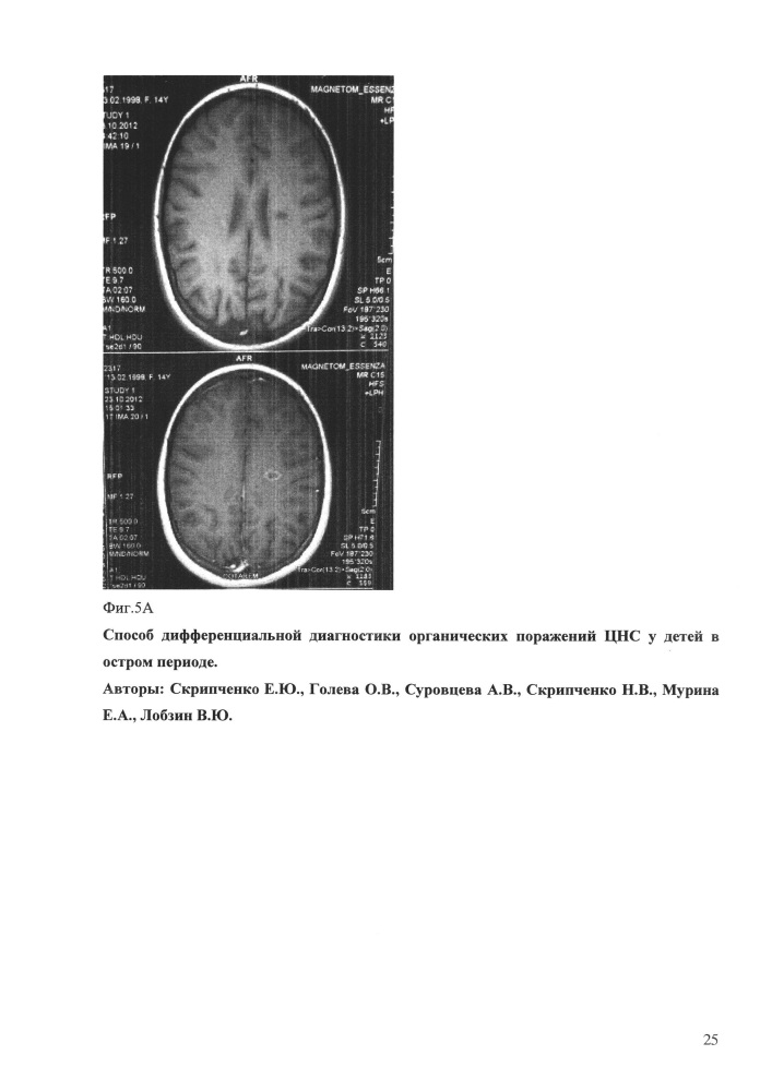 Способ дифференциальной диагностики органических поражений цнс у детей в остром периоде (патент 2648215)