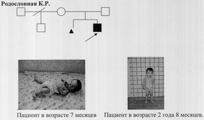 Способ диагностики 3-м синдрома в якутской популяции (патент 2315310)