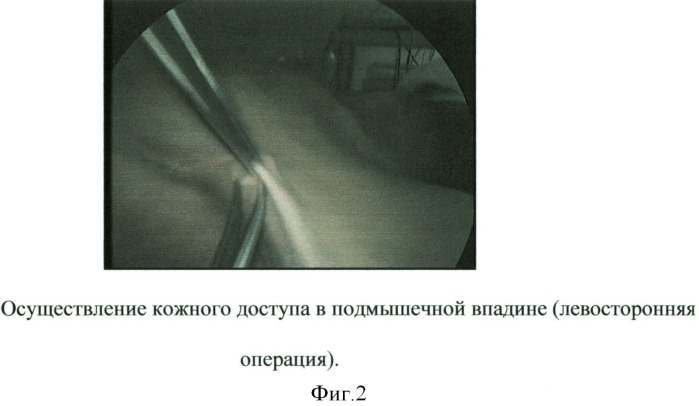 Способ эндовидеохирургического доступа к доле щитовидной железы (патент 2500355)
