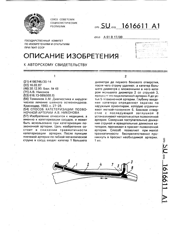 Способ а.в.никонова катетеризации позвоночной артерии (патент 1616611)