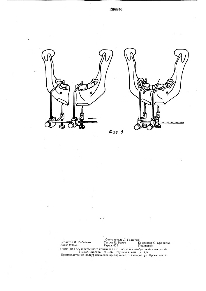 Устройство для репозиции отломков нижней челюсти (патент 1398840)