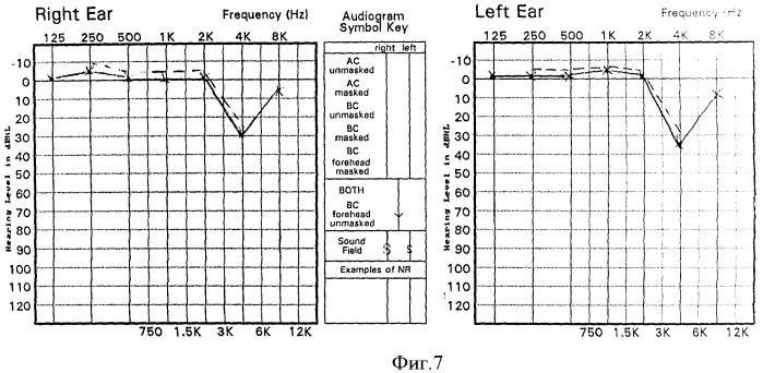 Способ диагностики профессиональной сенсоневральной тугоухости (патент 2412648)