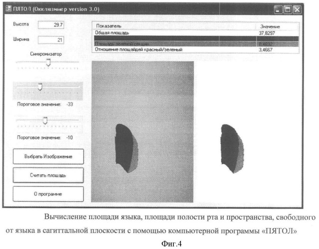 Способ диагностики аномалий зубочелюстной системы (патент 2360604)