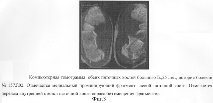 Способ оперативного лечения осложненного перелома пяточной кости (патент 2301032)