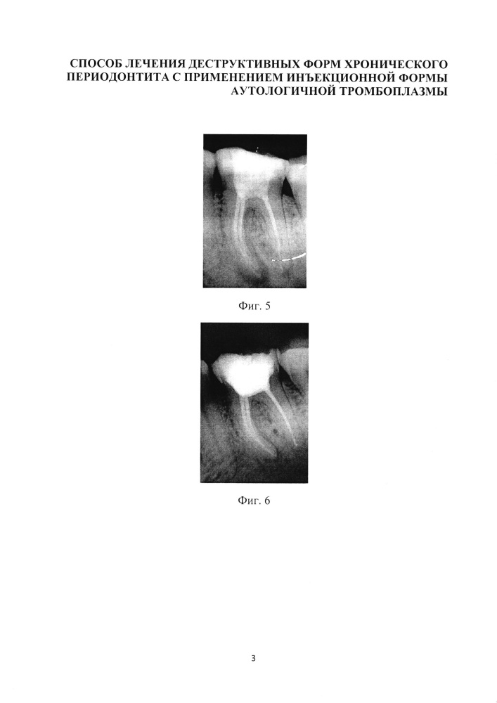 Способ лечения деструктивных форм хронического периодонтита с применением инъекционной формы аутологичной тромбоплазмы (патент 2627582)