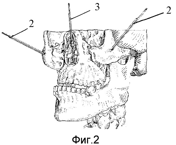 Способ внеочагового-стержневого остеосинтеза при переломах верхней челюсти по типу ле-фор - ii средний и комплект для его осуществления (патент 2430698)