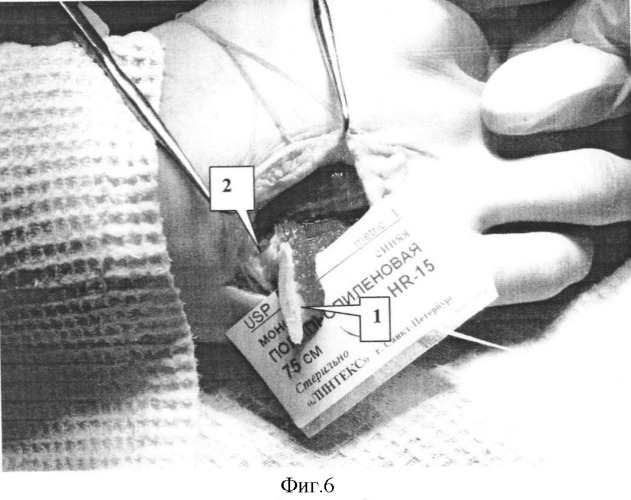 Способ пластики дефектов костей кисти при заболеваниях и последствиях повреждений (патент 2336044)
