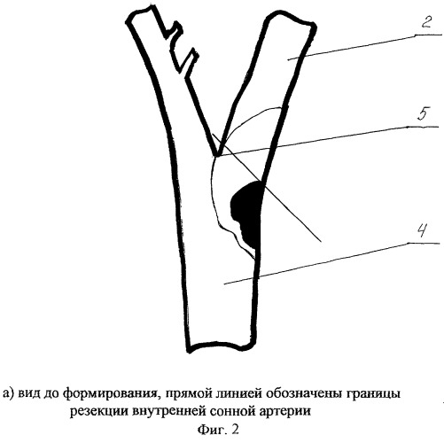 Анастомоз для восстановления нормального кровотока экстракраниального отдела внутренней сонной артерии, нарушенного патологическим процессом в области бифуркации (патент 2265410)