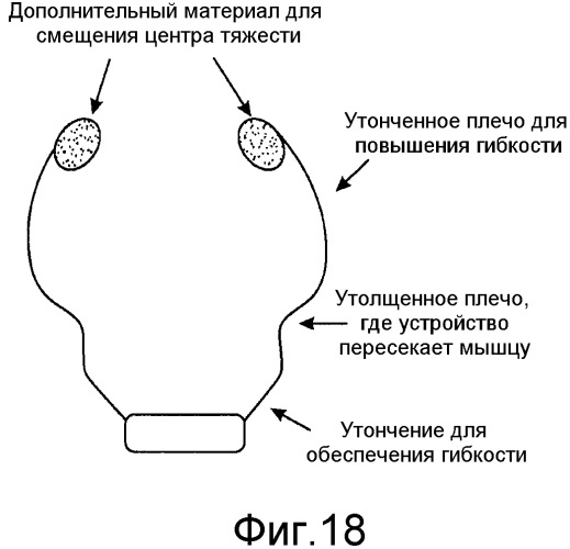 Коррекция стрессового недержания мочи (патент 2548825)