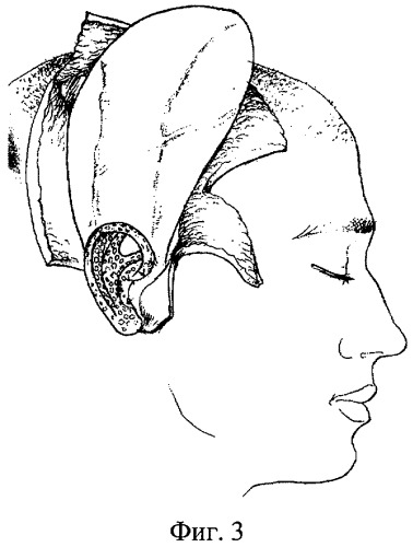 Способ устранения дефекта ушной раковины (патент 2360622)