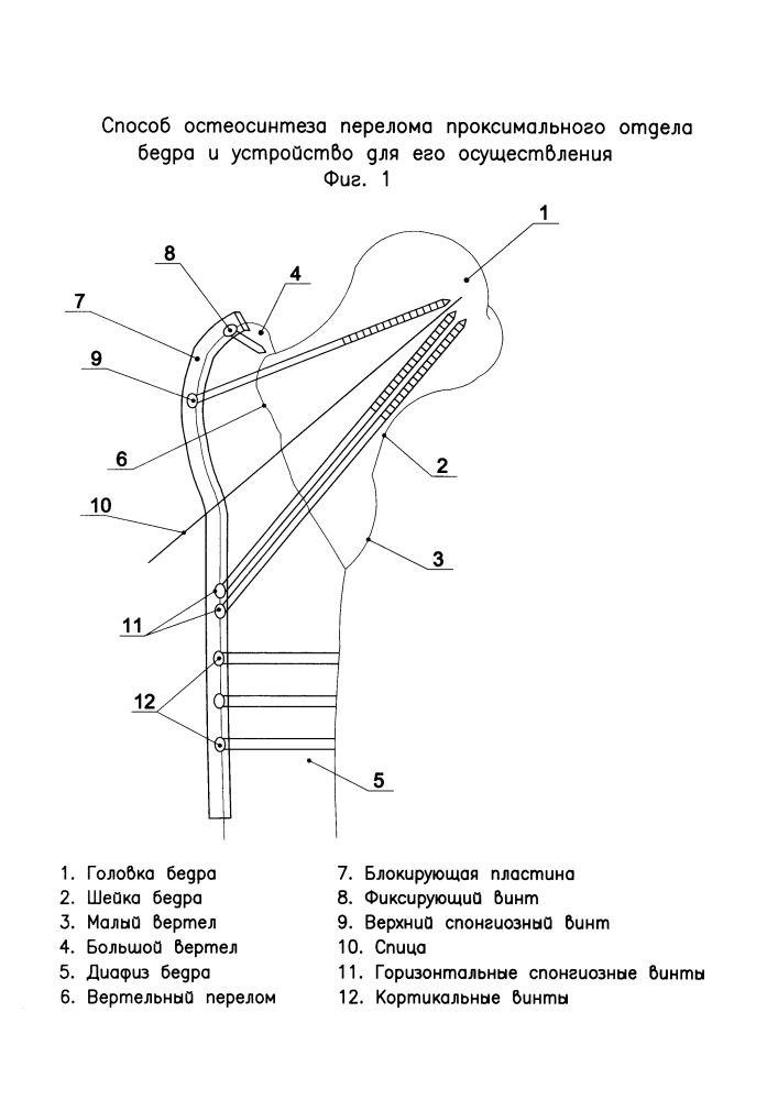Способ блокируемого остеосинтеза проксимальных переломов бедра и устройство для его осуществления (патент 2595090)