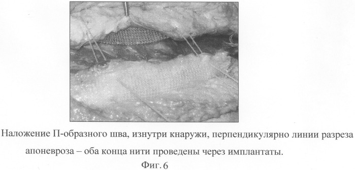 Способ ушивания апоневроза (патент 2277384)
