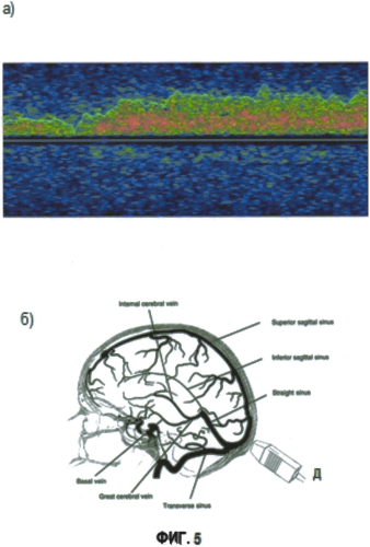 Способ определения скрытой церебральной венозной недостаточности у детей (патент 2549672)