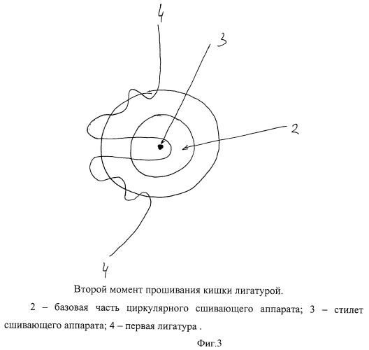 Способ формирования аппаратного колоректального анастомоза (патент 2476160)