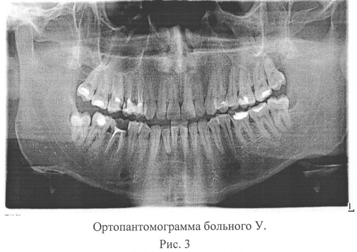 Способ оценки степени тяжести заболевания пародонта (патент 2546102)