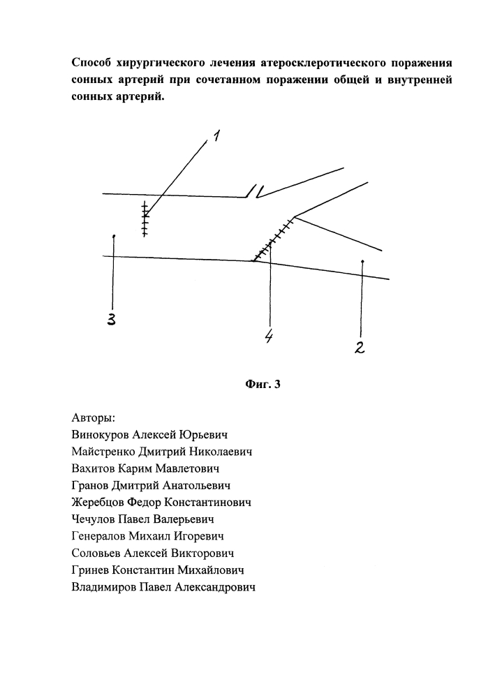 Способ хирургического лечения атеросклеротического поражения сонных артерий при сочетанном поражении общей и внутренней сонных артерий (патент 2623650)