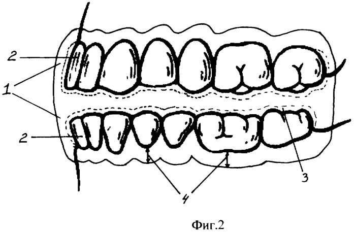 Зубные шины для массажа (патент 2306917)