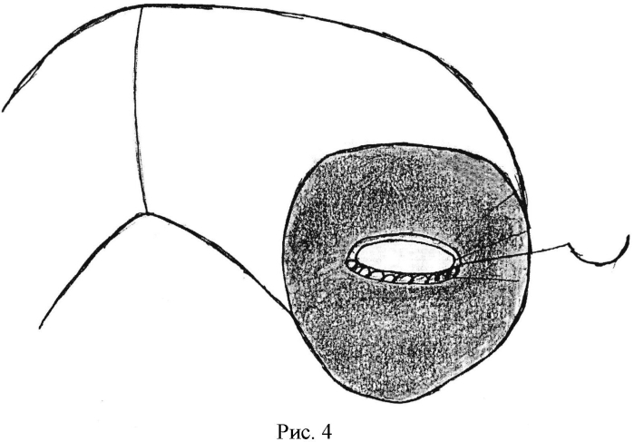 Способ хирургического лечения кист головки поджелудочной железы (патент 2571711)