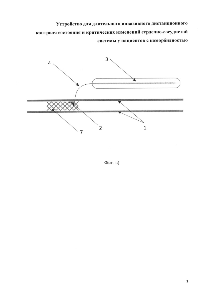 Устройство для длительного инвазивного дистанционного контроля состояния и критических изменений сердечно-сосудистой системы у пациентов с коморбидностью (патент 2613086)