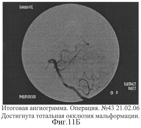 Способ эмболизации артериовенозных мальформаций головного мозга в условиях общей анестезии и управляемой гипотонии (патент 2315634)