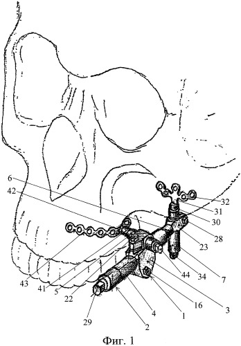 Способ устранения деформации и/или недоразвития скуловой кости врожденого или приобретенного характера и устройство для восстановления рельефа и объема скуловой области (патент 2329776)
